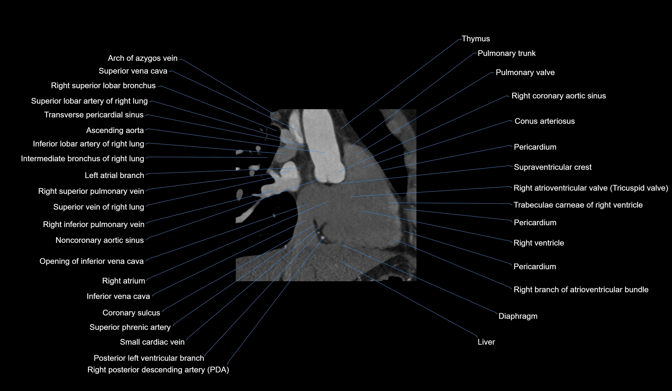 CT heart (coronary angiogram) 2 chamber view cross sectional anatomy labelled radiology image-00026.webp